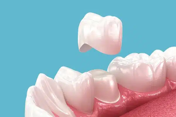 Dental crown restoration