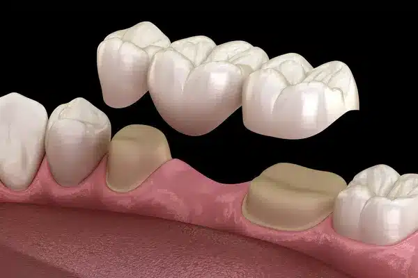 Dental bridge restoration