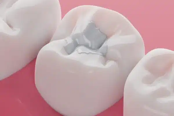 Tooth-colored dental filling